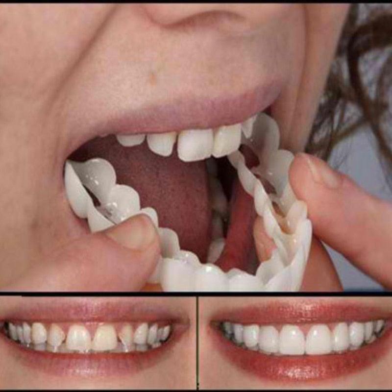 Lente de Contato Dental | Snap On Smile | Removível Inferior e Superior– Resina Tooth